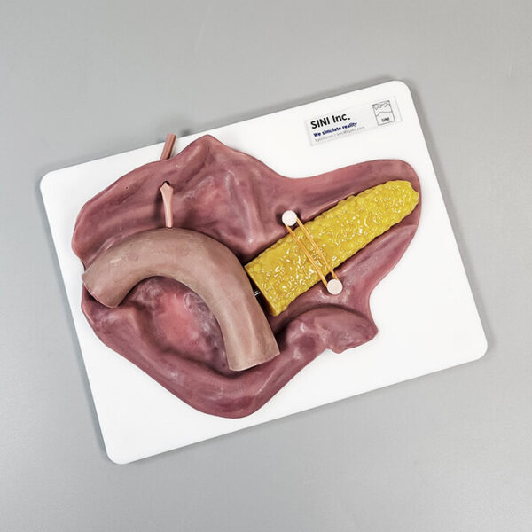 Pancreatojejunostomy Anastomosis Plate